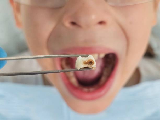 Best Emergency Tooth Extraction in El Centro, CA